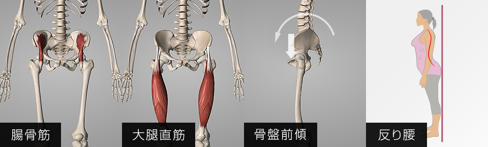 大腿直筋・腸骨筋が硬くなると骨盤が前傾し反り腰の原因になる